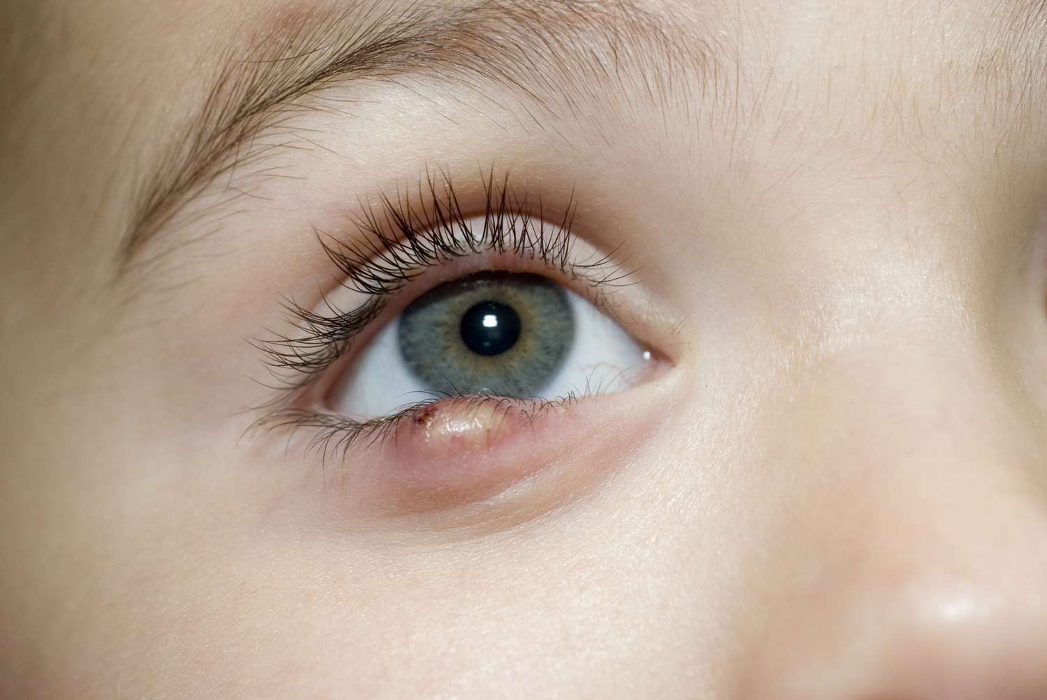 A child in natural light with a small localized bump visible on the upper eyelid