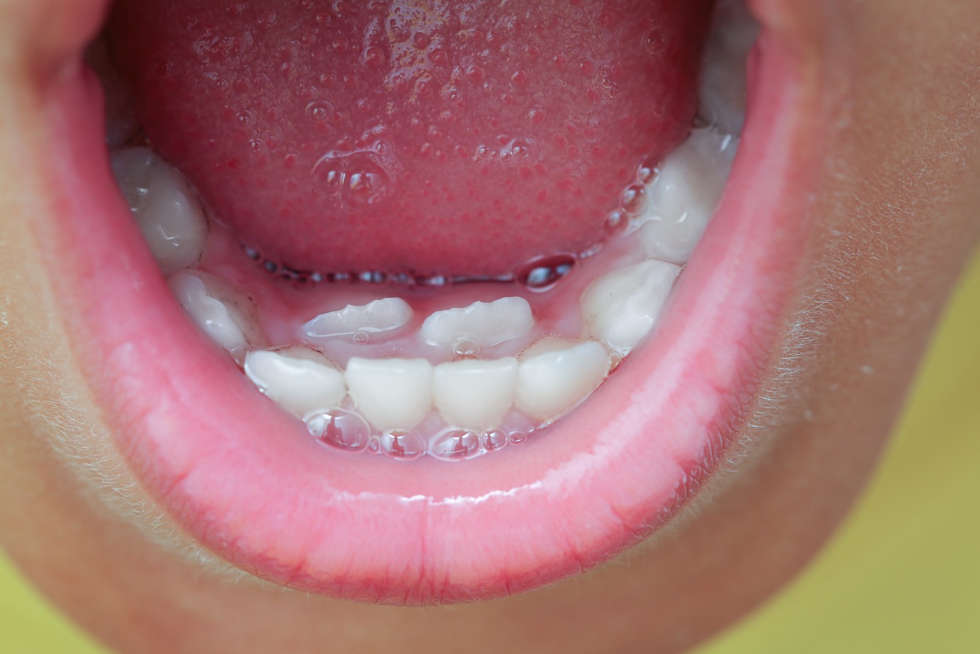 A close-up of a child's lower front teeth with a permanent tooth erupting behind a baby tooth, realistic dental photo with neutral background