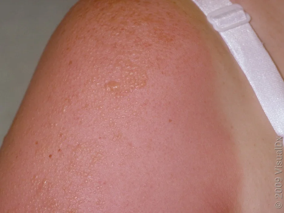 A close-up of a toddler's shoulder with a small sunburn blister covered by a loose nonstick gauze pad secured with gentle tape, realistic photograph