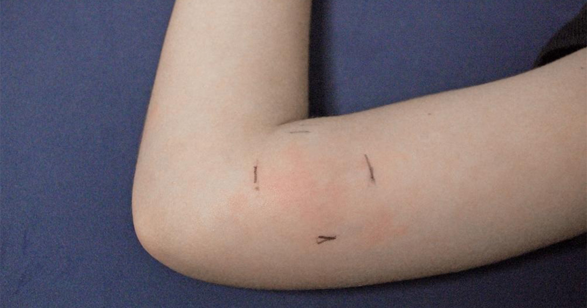 A close-up photo of a child’s forearm with a raised, red, tender-looking boil with surrounding pink skin in a softly lit home setting