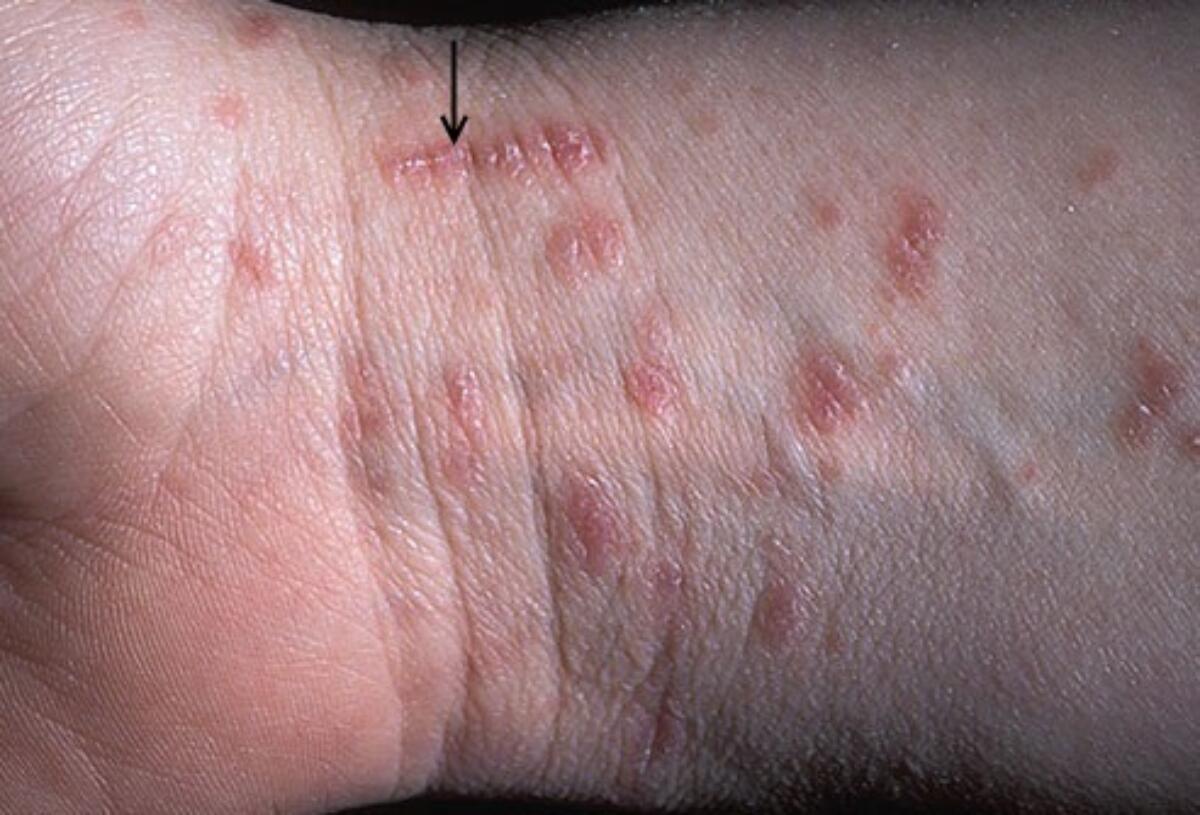 A close-up photo of a child's hand showing small red bumps and scratch marks in the webbing between the fingers, realistic clinical photography