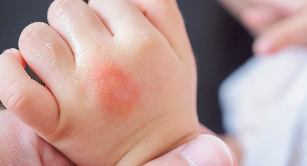 A close-up photo of a child’s hand with visible swelling and redness around a small bite wound, taken indoors in natural window light