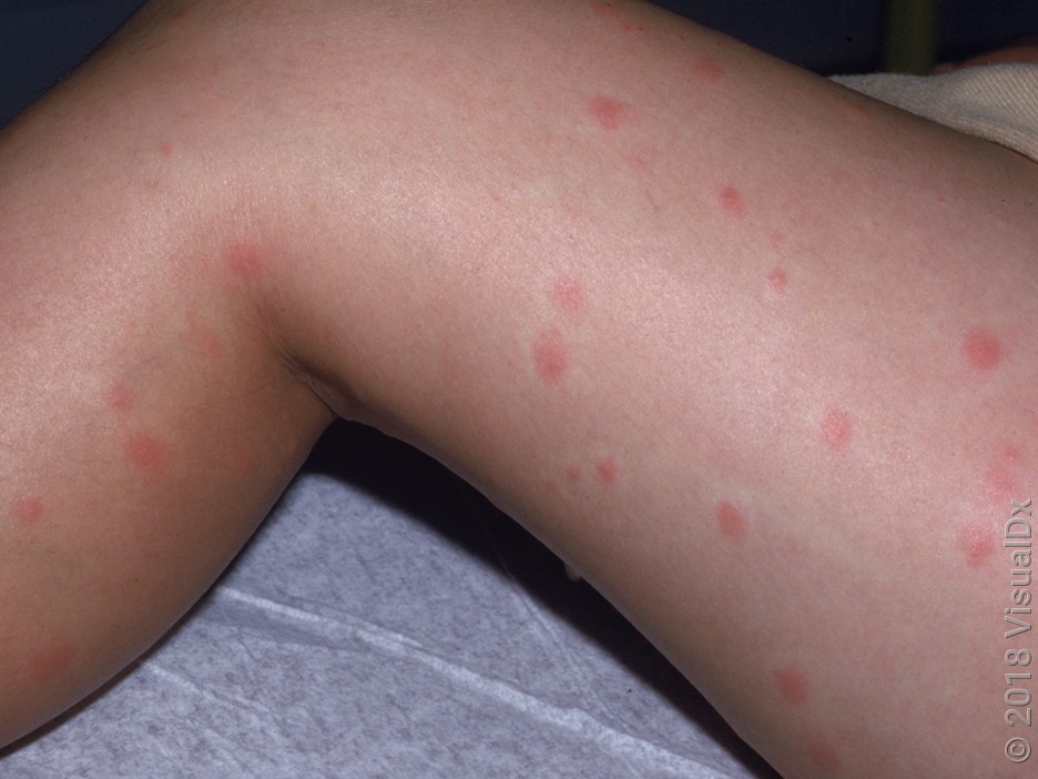 A close-up photo of a child’s lower leg with scattered small red itchy bumps after freshwater swimming, sharp focus, realistic skin texture