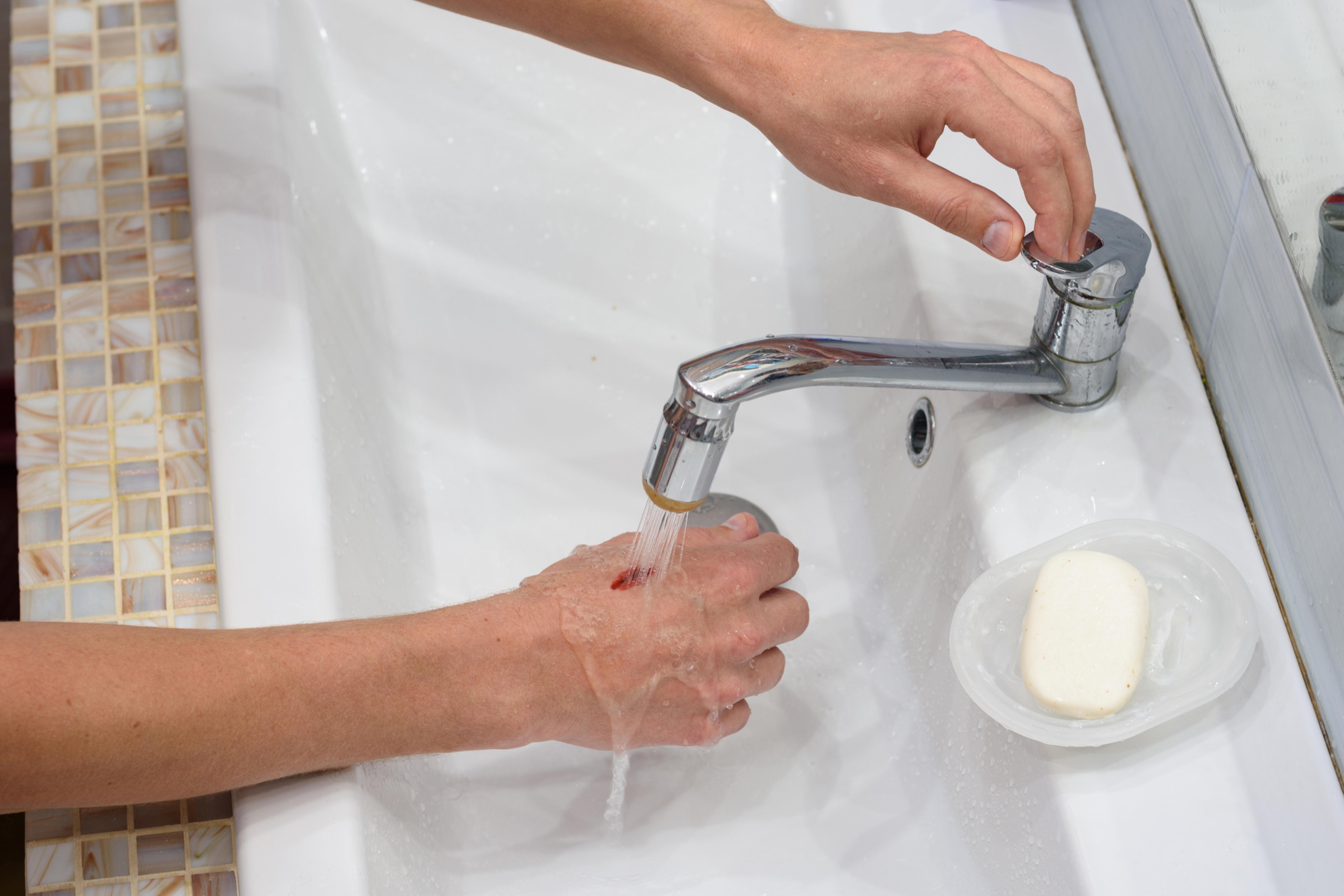 A close-up photo of an adult gently rinsing a small dog bite wound on a child’s hand under running tap water at a bathroom sink, realistic indoor lighting