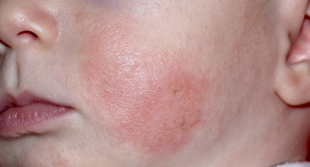 A close-up photo of an infant’s cheek with a dry, slightly red, rough patch of skin consistent with eczema, soft natural window light, photorealistic