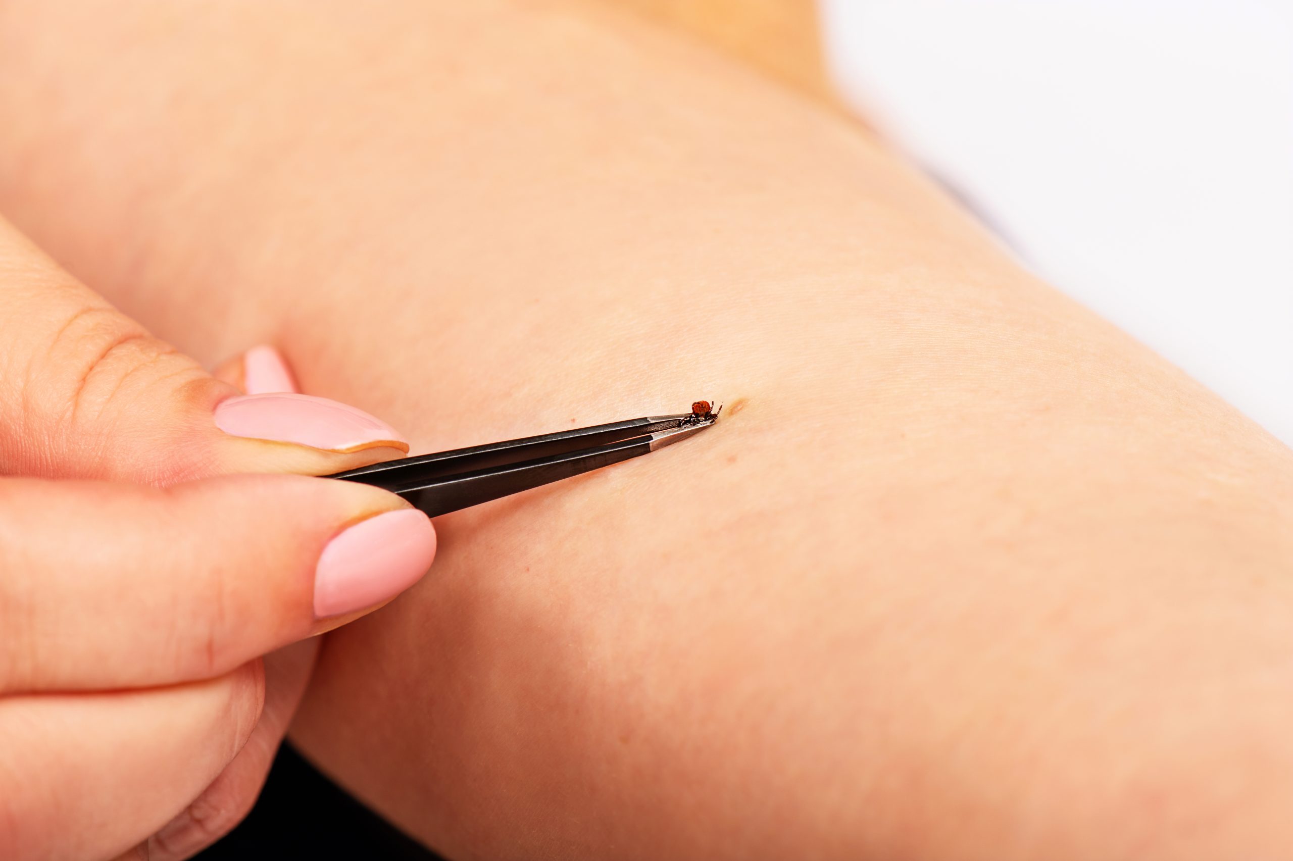 A close-up photo of fine-tipped tweezers grasping a small tick at the skin surface on a child’s leg, realistic clinical lighting