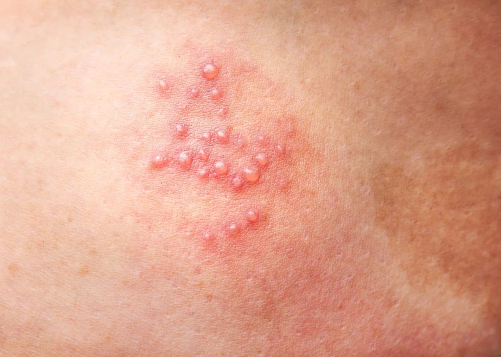 A close-up photo of small clustered blisters on a child’s skin along the ribcage in a narrow band pattern