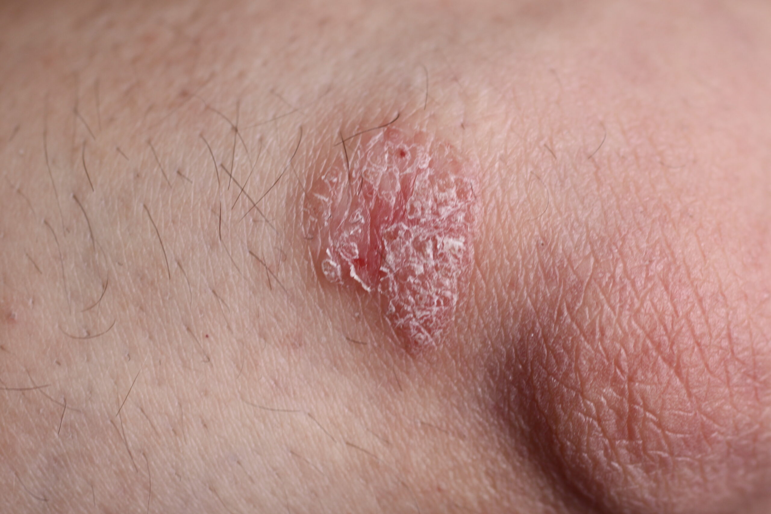 A close-up photograph of a child’s elbow with a well-defined pink plaque and fine whitish scale on the surface, natural window light