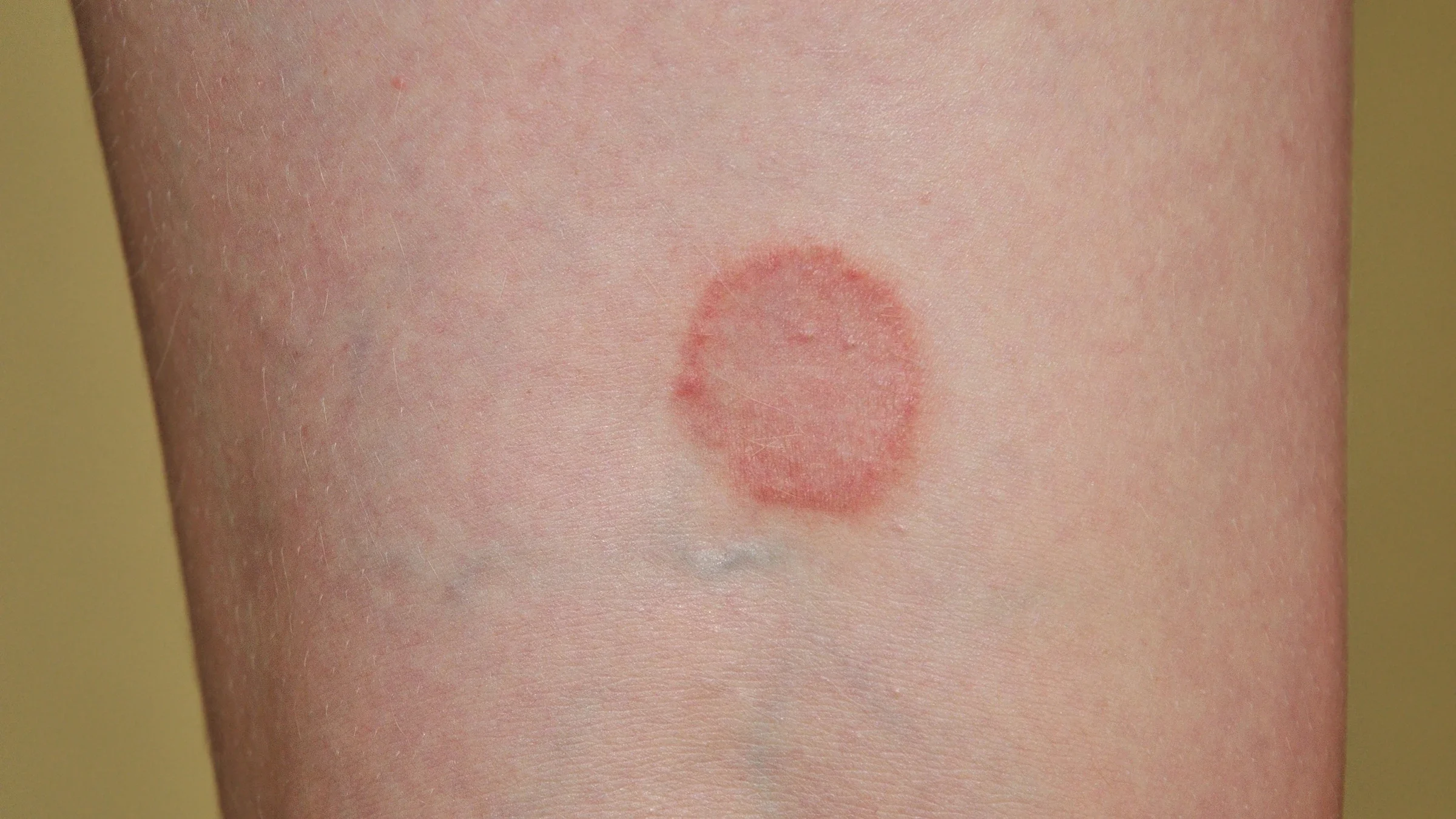 A close-up photograph of a child’s forearm showing a round, ring-shaped rash with a slightly raised, scaly border and clearer skin in the center, taken in natural indoor light