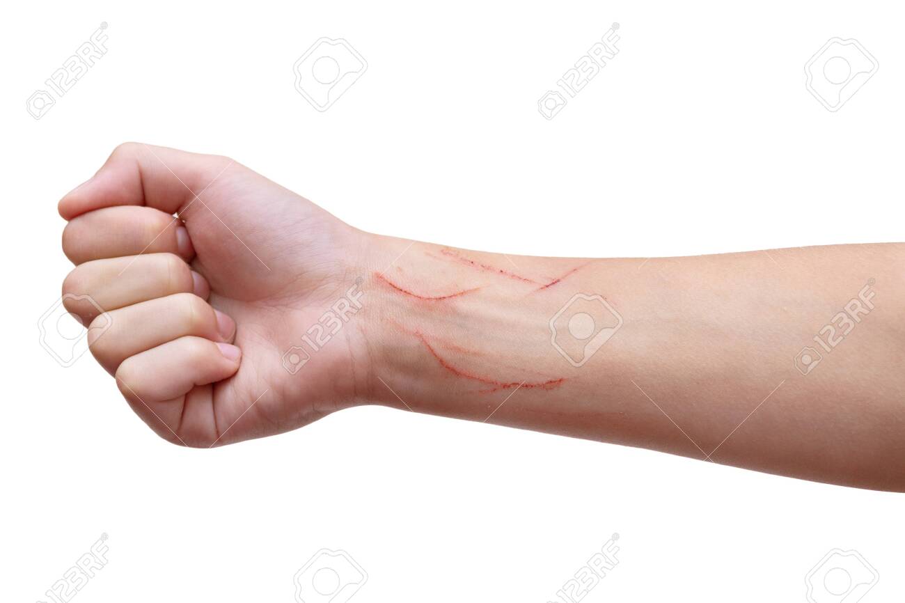 A close-up photograph of a child's forearm with a small healing cat scratch and mild redness in natural indoor light