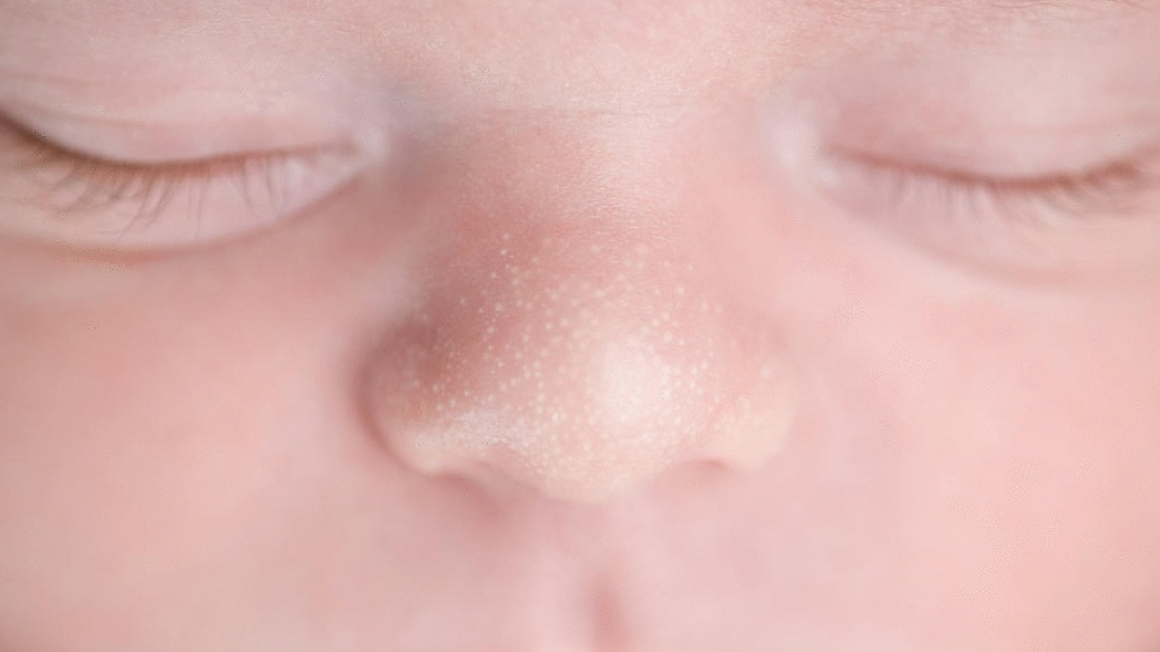 A close-up photograph of a newborn baby’s face showing several tiny pearly white bumps clustered on the nose and upper cheeks in soft natural window light