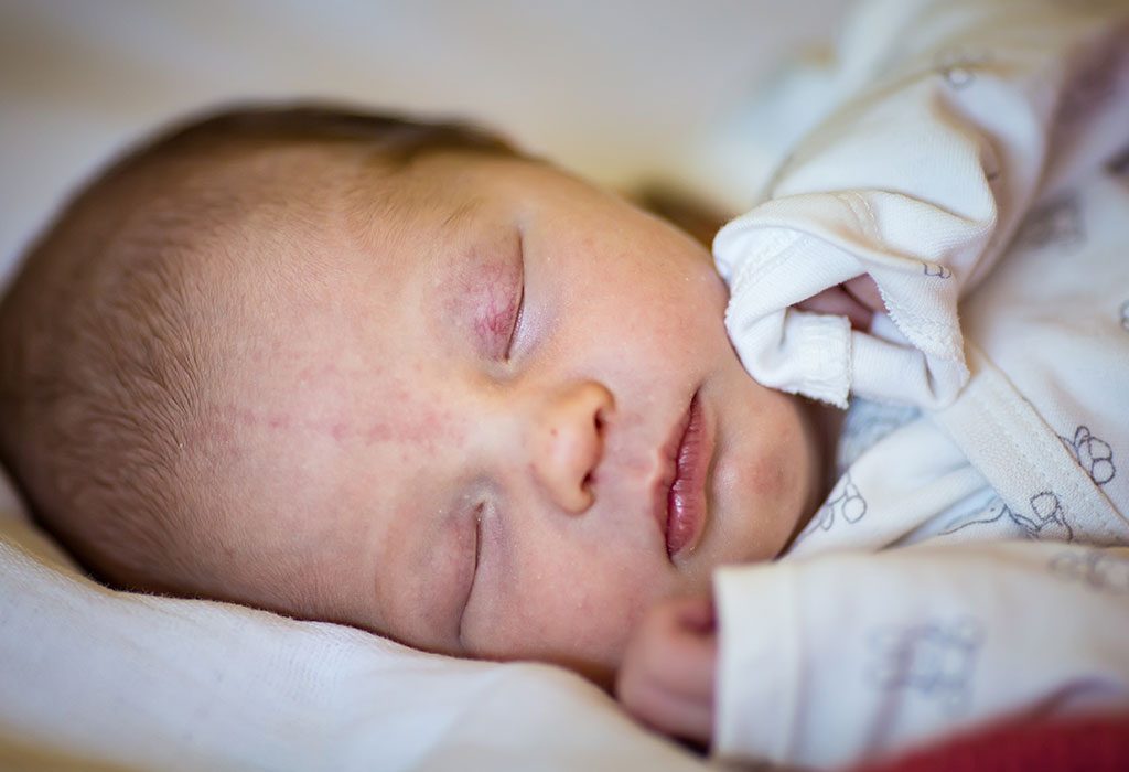 A close-up photograph of a newborn’s face in soft natural light with a faint flat pink patch on the upper eyelid