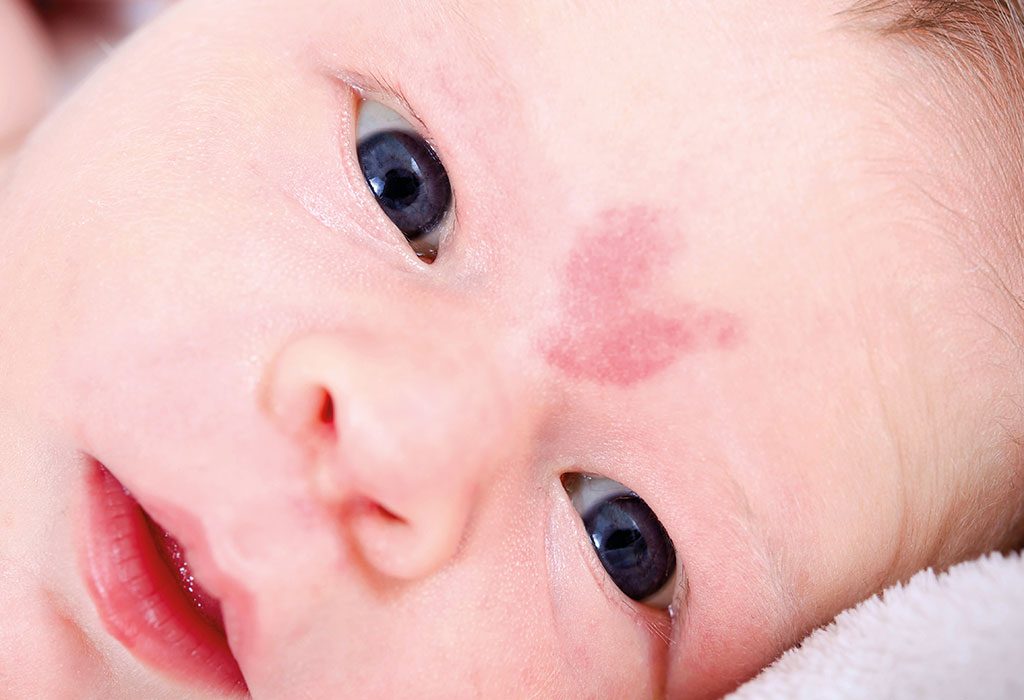 A close-up photograph of a sleeping newborn in a hospital bassinet with a faint flat pink patch on the center of the forehead, soft natural window light
