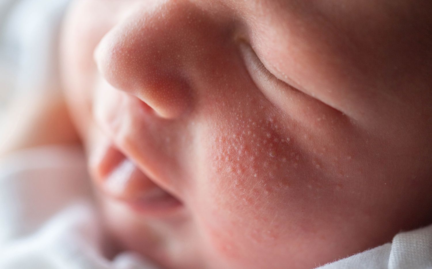 Common Baby Rashes: What’s Normal and What’s Not