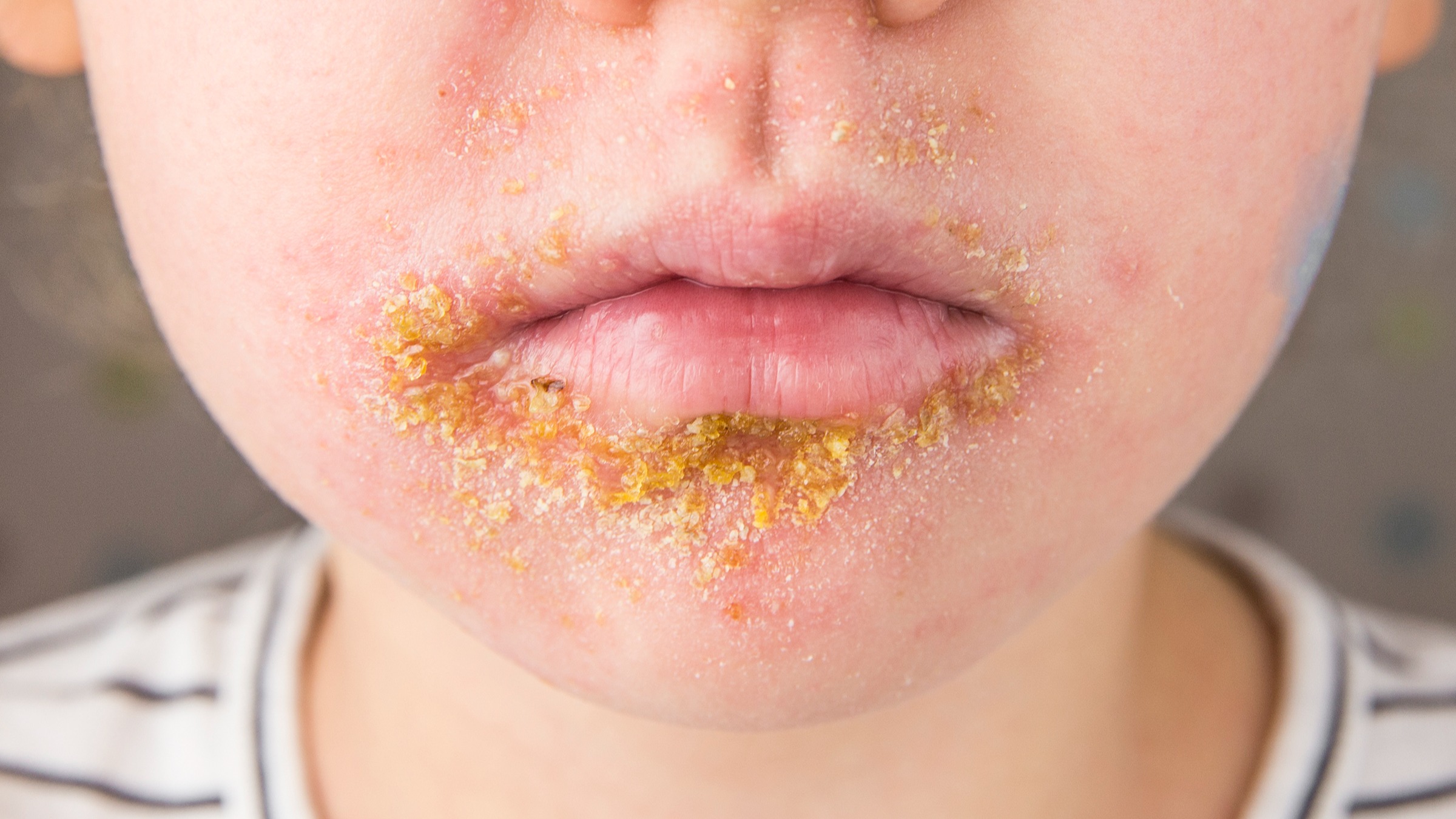 A close-up real-life photo of a child’s cheek with small honey-colored crusted patches near the mouth, consistent with impetigo