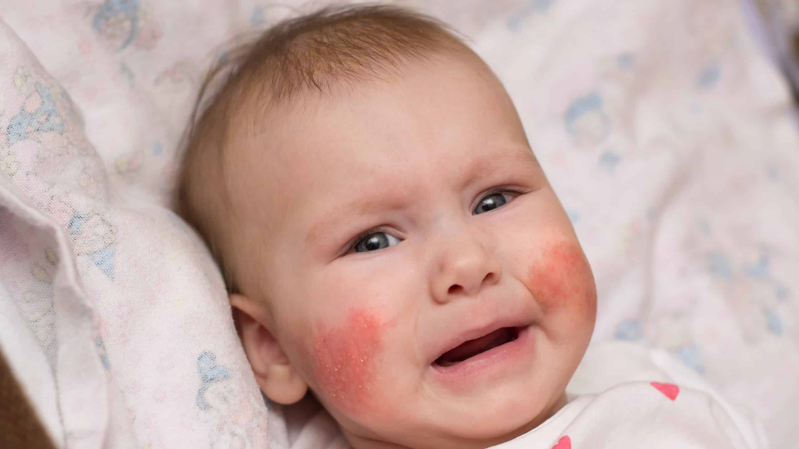 A close-up real photo of a baby with mild eczema redness on the cheek while sitting on a parent’s lap indoors, natural light