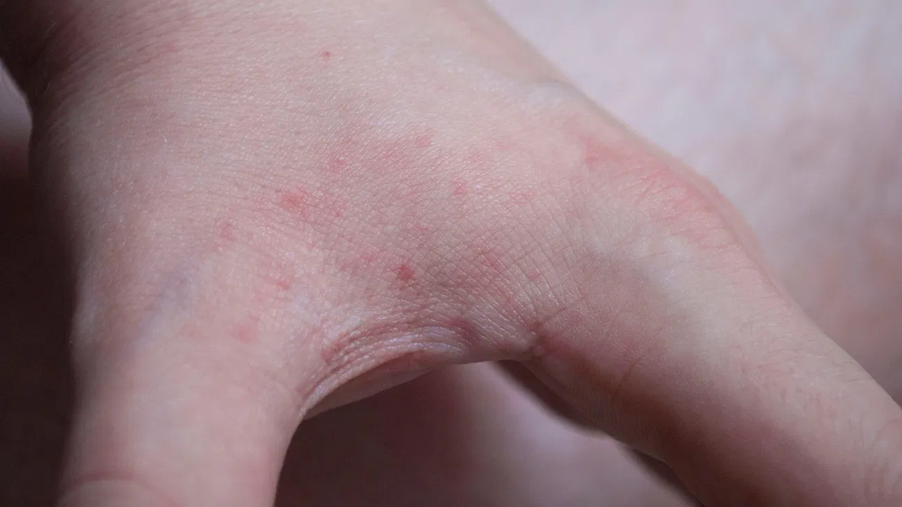 A close-up real photo of a child’s forearm with several small, red, itchy-looking bumps clustered in a loose line, photographed in soft morning light near a bedroom