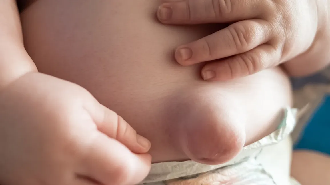 Umbilical Hernia in Babies: What It Looks Like and When to Worry