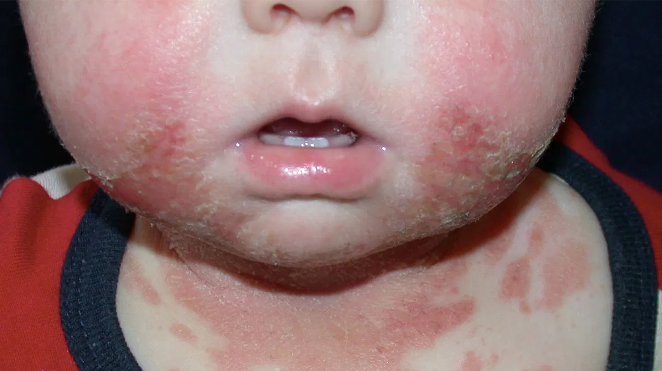 Teething Rash and Drool Rash in Babies