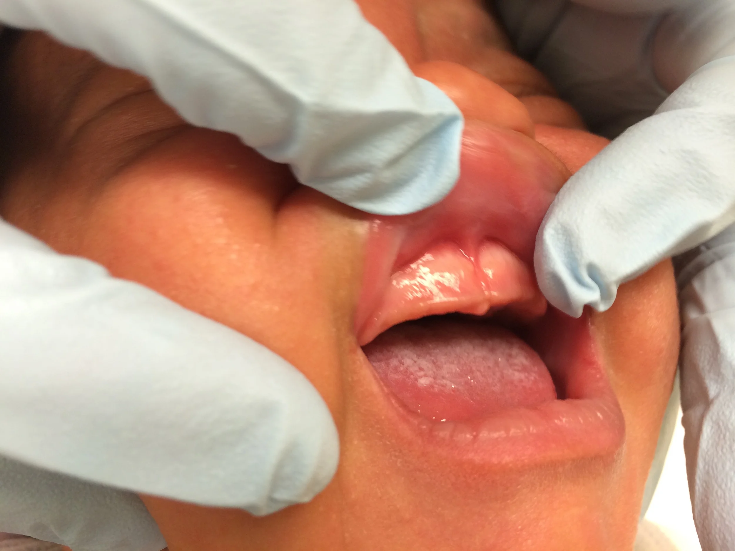 A close-up real photograph of a baby’s upper lip lifted, showing a prominent upper frenulum attaching low near the front gum ridge