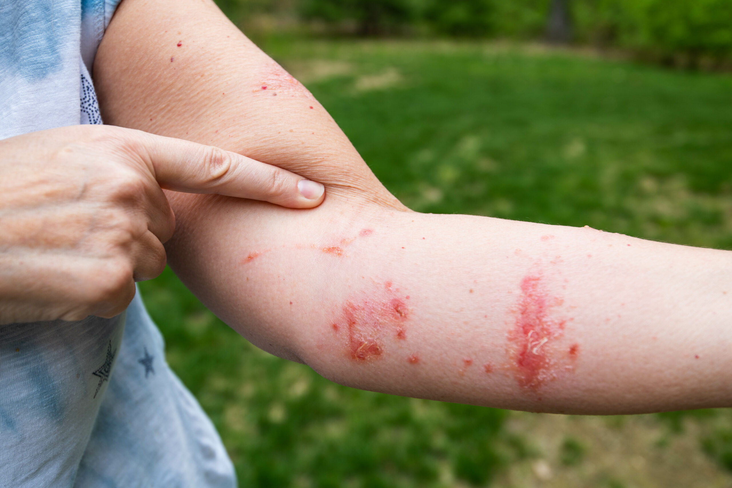 Poison Ivy, Oak, and Sumac in Kids