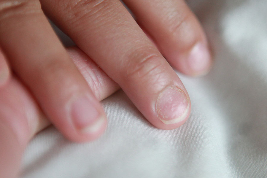 A close-up real photograph of a child’s hand showing fingernails with small shallow pits and slight surface roughness in natural light