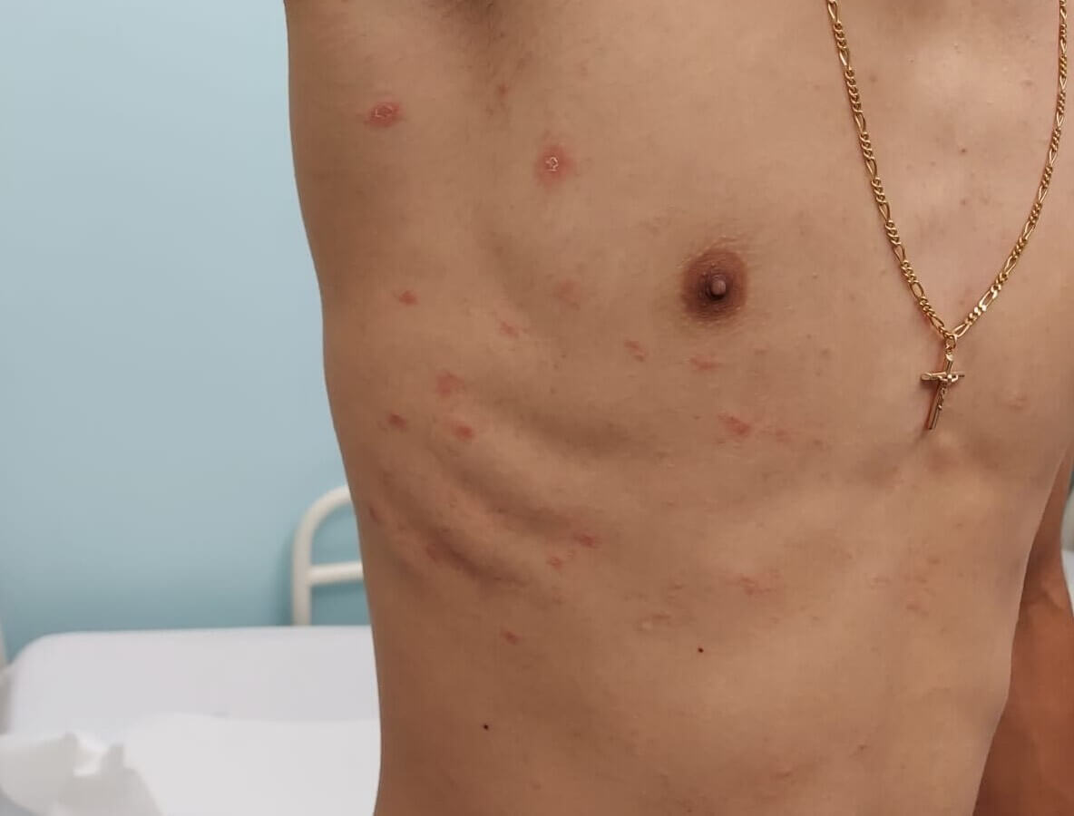 A close-up real photograph of a child’s torso with one larger oval pink patch with faint scaling at the edge consistent with a herald patch, natural light