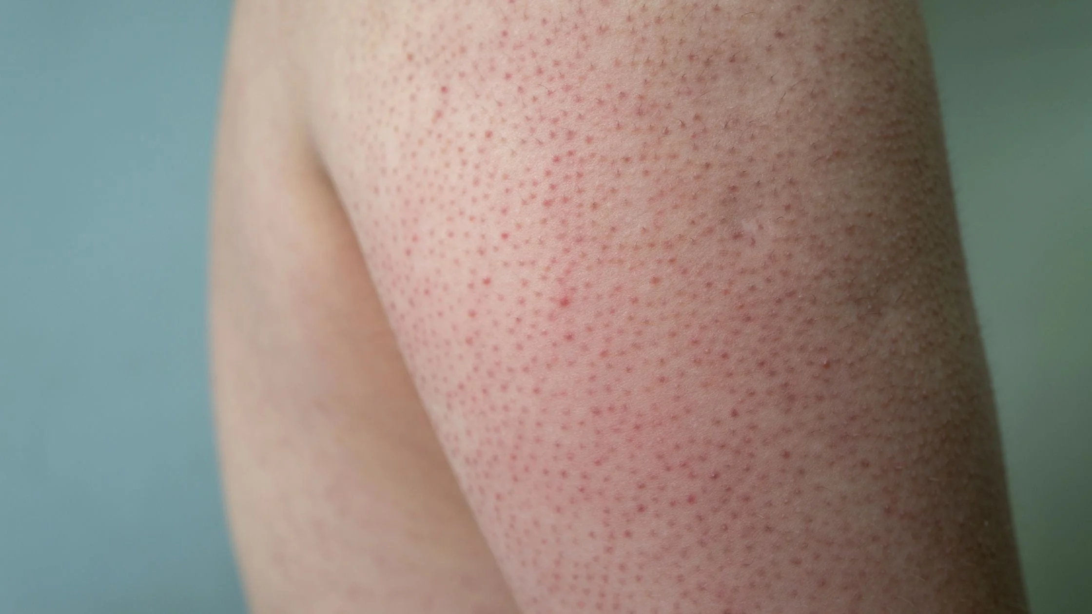 A close-up real photograph of a child’s upper arm showing tiny, flesh-colored to pink bumps clustered around hair follicles with a slightly dry, rough texture