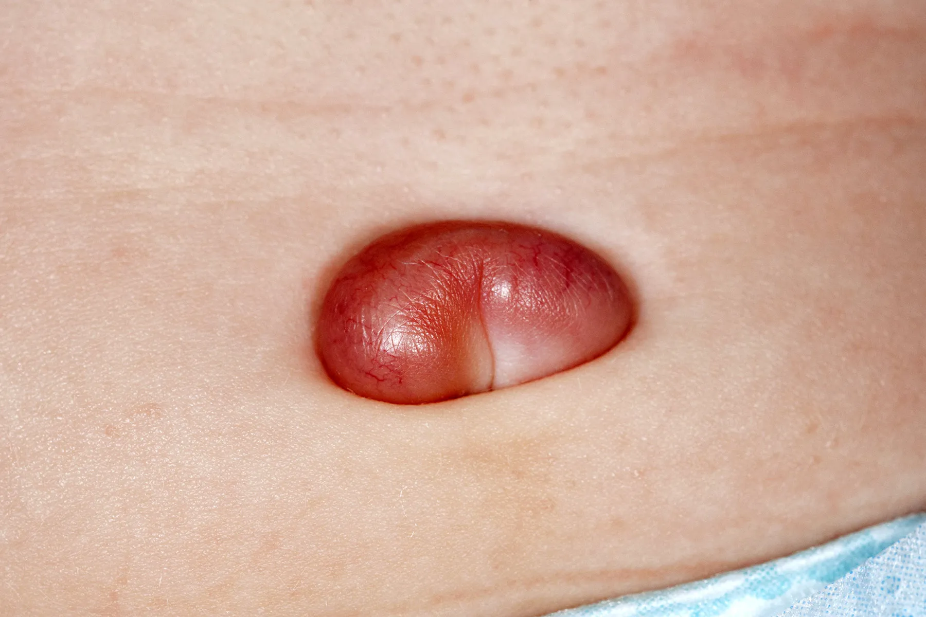 A close-up real photograph of a newborn baby’s belly button with a small moist pink-red bump at the center and a tiny amount of clear-yellow drainage on surrounding skin, natural indoor lighting