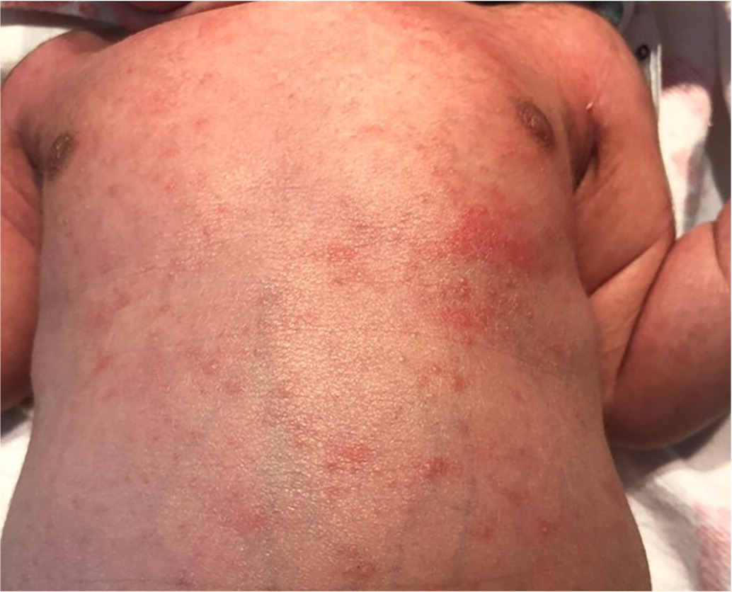A close-up real photograph of a newborn baby's torso with scattered red blotches and small yellow-white bumps typical of erythema toxicum, natural indoor light