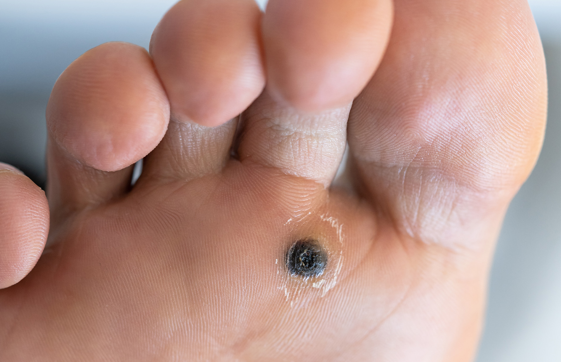A close-up real photograph of the sole of a child’s foot showing a single plantar wart with a slightly thickened callused area, neutral indoor lighting