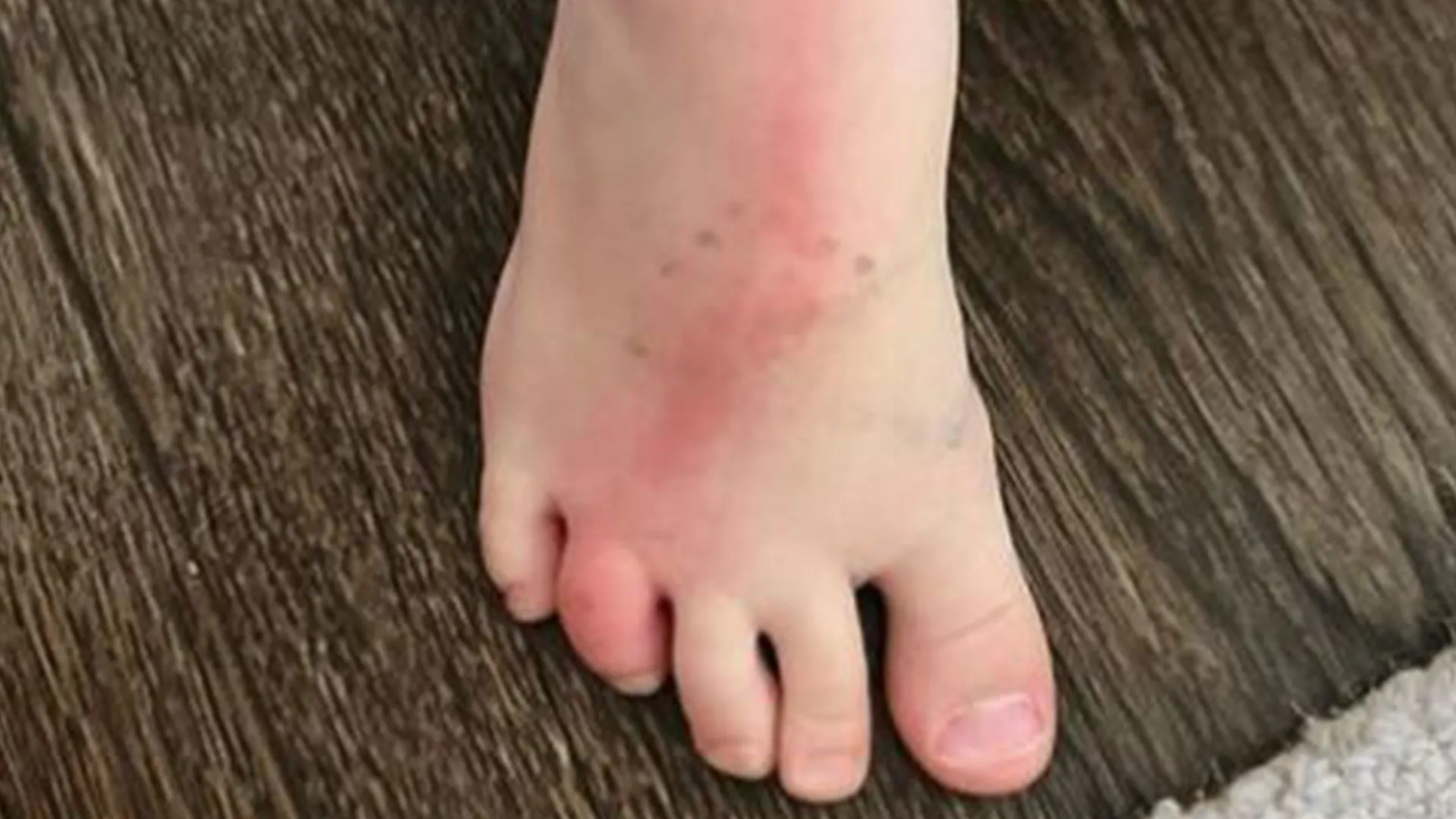 A parent gently drawing a thin line around the edge of redness on a child's leg near a skin infection to track spreading, realistic photo