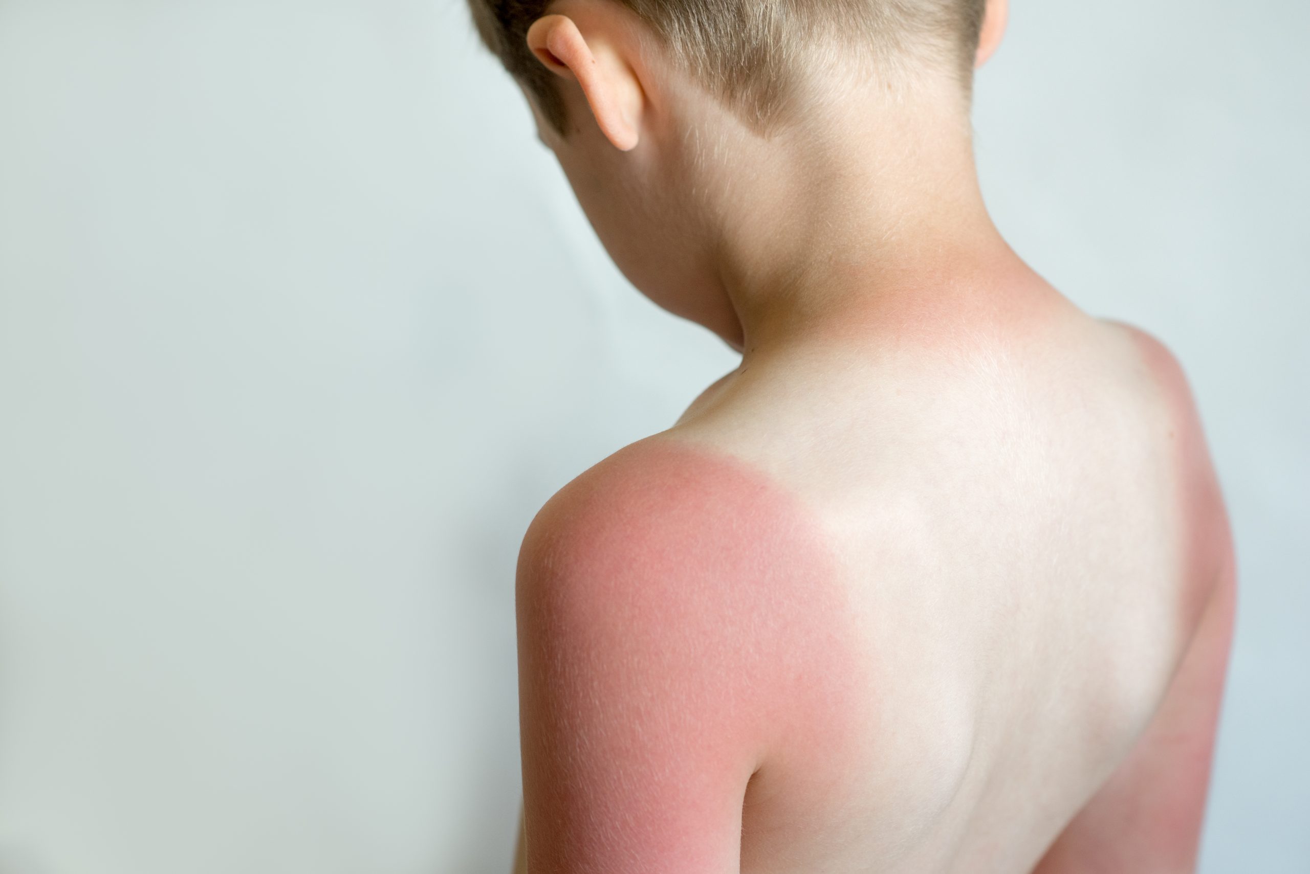 How to Treat a Toddler’s Sunburn Safely