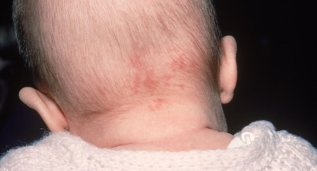 A photograph of a swaddled newborn seen from behind, showing a flat pink patch at the nape of the neck in soft indoor light
