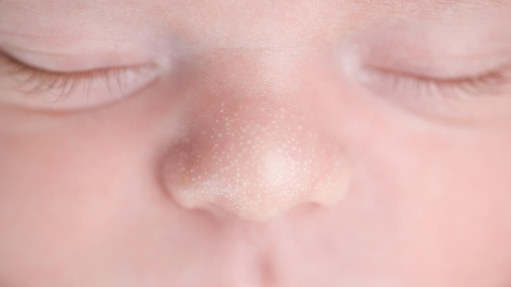 A photorealistic close-up of a newborn’s nose and cheeks with multiple tiny white milia bumps, gentle natural light, sharp skin detail