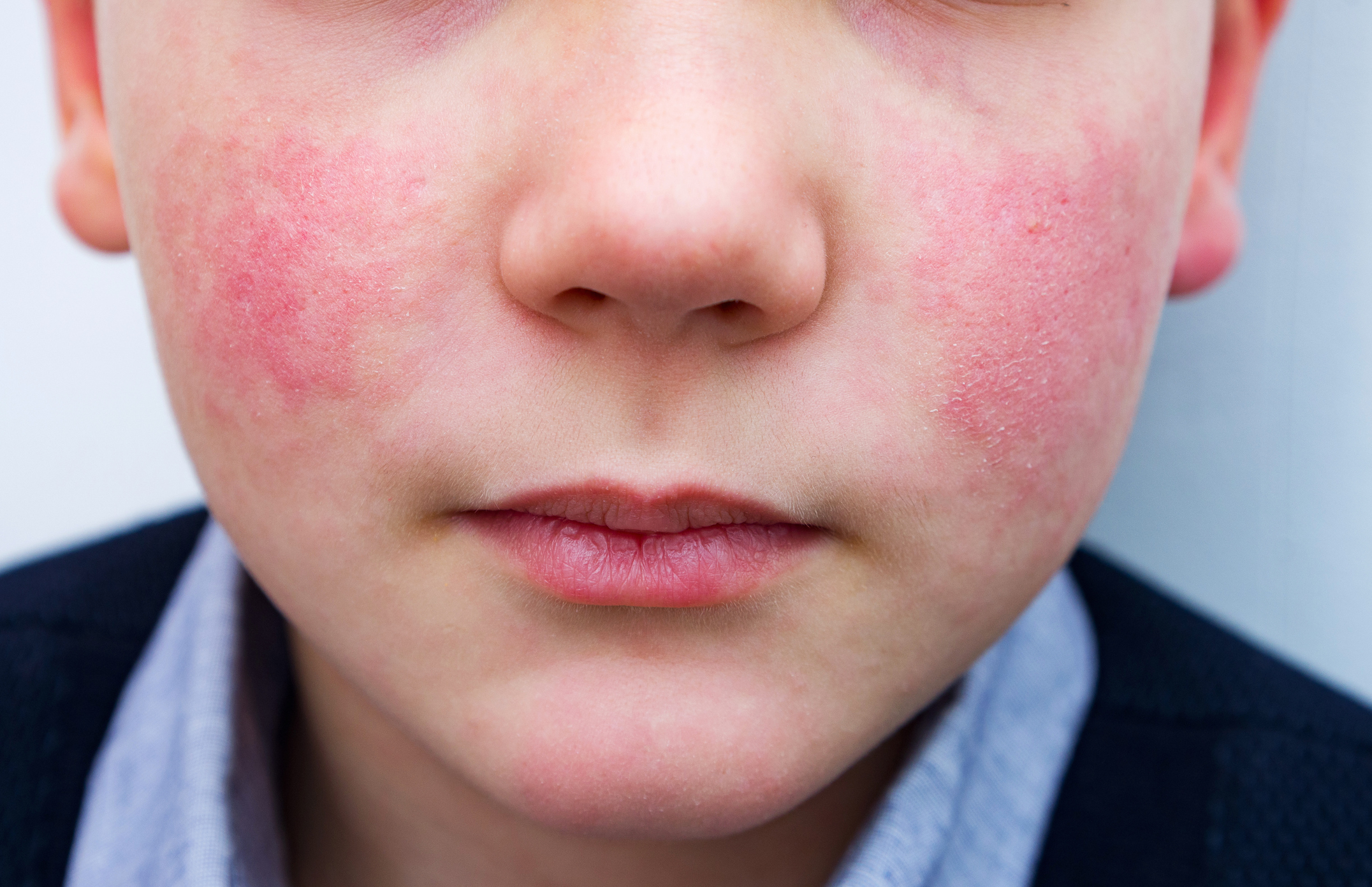 A photorealistic close-up of a young child’s face with bright red cheeks consistent with a slapped-cheek rash, neutral indoor lighting, shallow depth of field