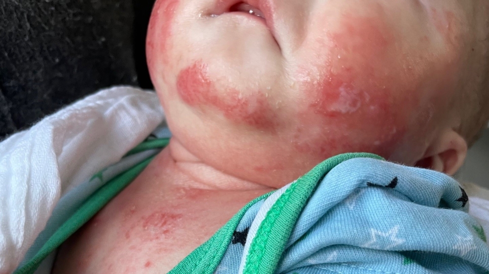 A real close-up photo of a baby neck fold with mild redness and moisture irritation under the chin in natural indoor light