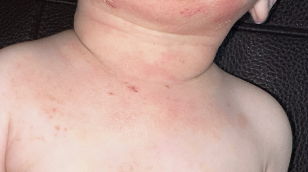 A real photo close-up of a toddler’s neck folds showing mild heat rash with tiny red bumps, soft natural window light