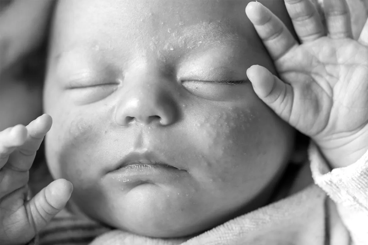 A real photo of a parent gently applying a small amount of ointment to a baby’s chin with clean hands in a softly lit home