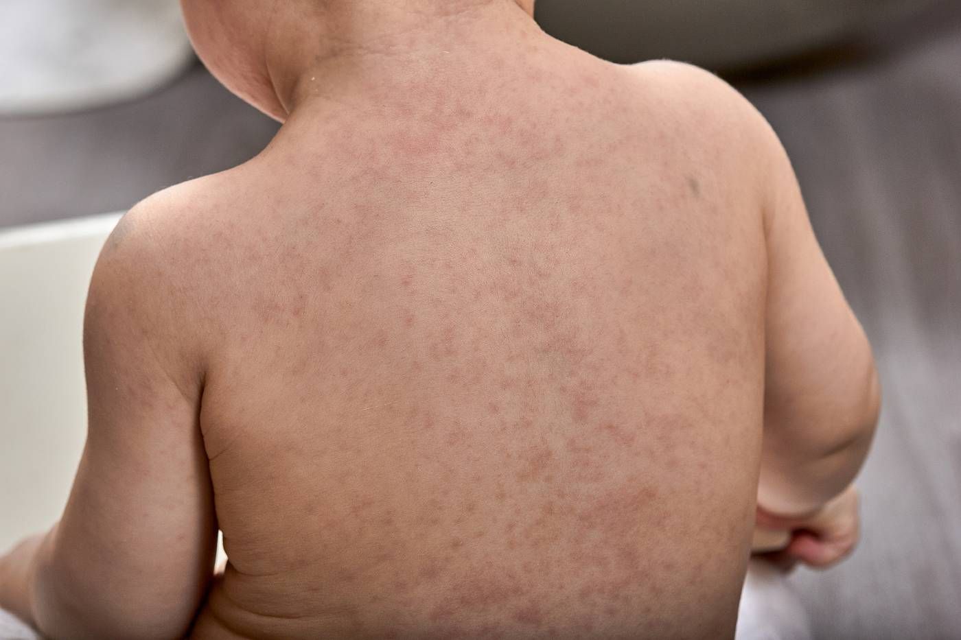 A real photo style close-up of a child’s upper back with faint, irregular patches and subtle fine scaling in natural light