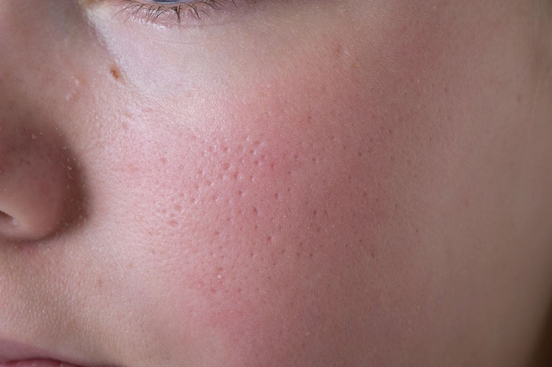 A real photograph of a child’s cheek in soft natural light with small rough bumps and mild redness on the cheek area consistent with keratosis pilaris