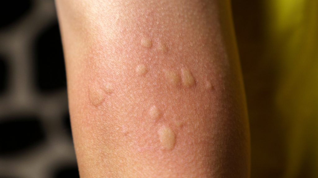A real photograph of a child’s forearm with several raised, pale-centered, pink welts consistent with hives, with the surrounding skin otherwise normal