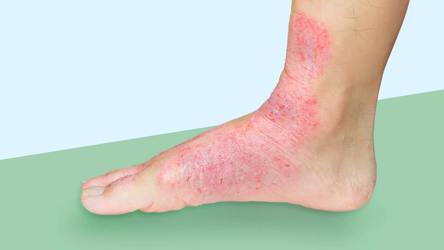 A real photograph of a child’s lower leg and ankle showing several red, streaky patches of contact dermatitis after outdoor play, neutral indoor lighting