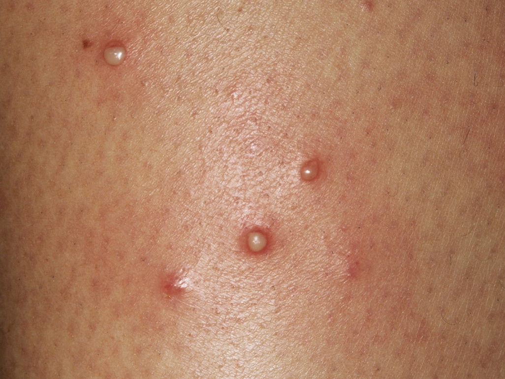 A real photograph of a child’s lower leg showing several small red bumps with a few tiny whiteheads centered on hair follicles, suggestive of folliculitis
