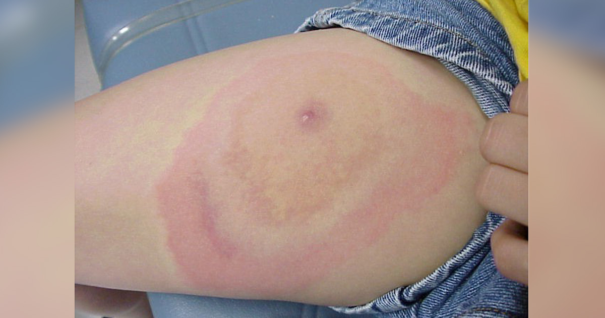 A realistic photo of an expanding red erythema migrans rash on a child’s forearm, soft indoor light, medical photo style