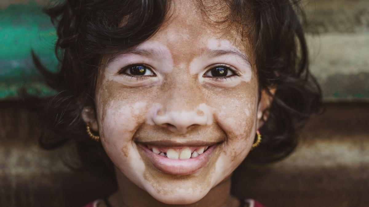 A school-age child outdoors in soft daylight with a clearly defined depigmented patch on one cheek, natural lifestyle photography