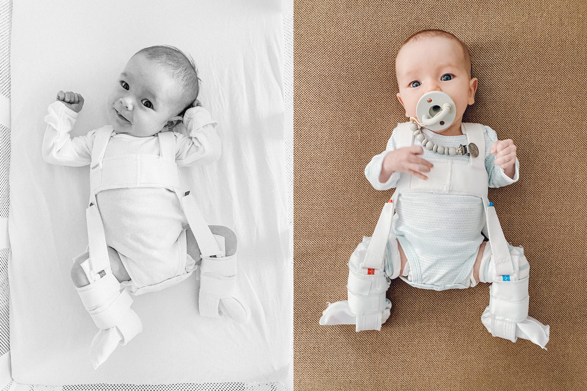 An infant lying on a blanket at home wearing a Pavlik harness, looking calm while a parent gently adjusts clothing around the straps, realistic photo