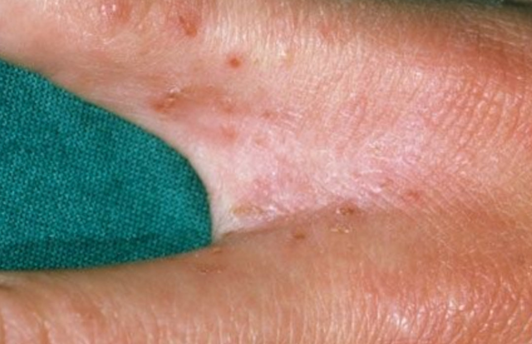 Close-up of a child’s finger web space with a faint thin line and surrounding small red bumps that can be seen with scabies