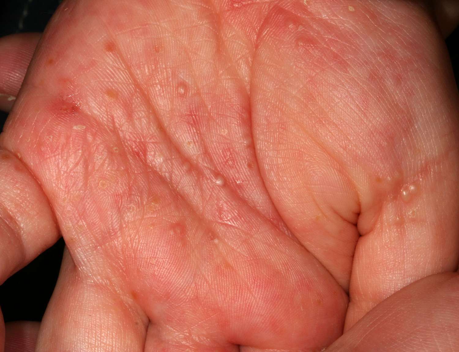 Scabies in Kids: What It Looks Like and How to Treat It