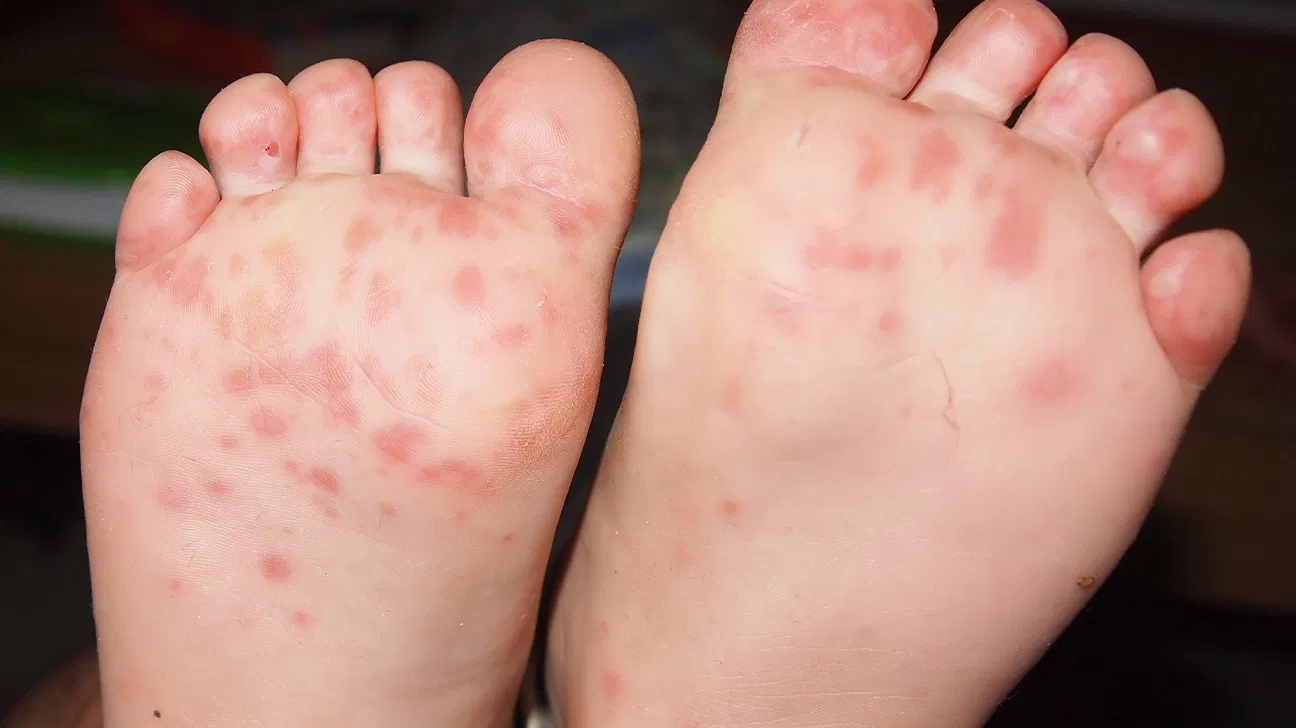 Close-up of an infant's feet with a few small red spots on the sole, natural light, clinical but non-graphic photo